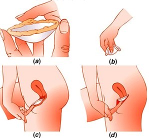 Chọn cách tránh thai theo độ tuổi và tình trạng quan hệ tình dục - 2