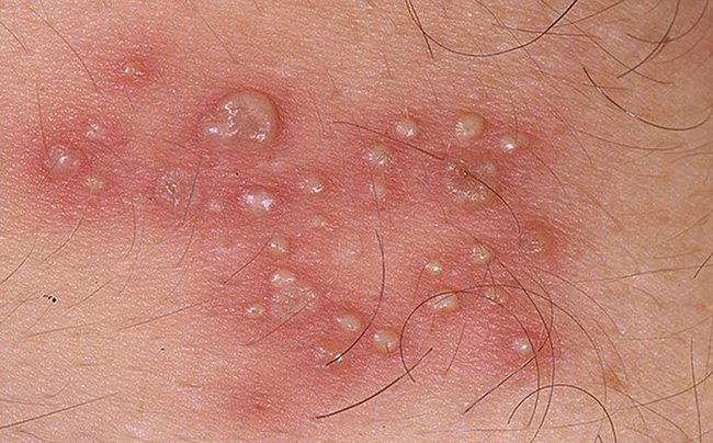 Các triệu chứng Herpes ở phụ nữ không nên bỏ qua - 3