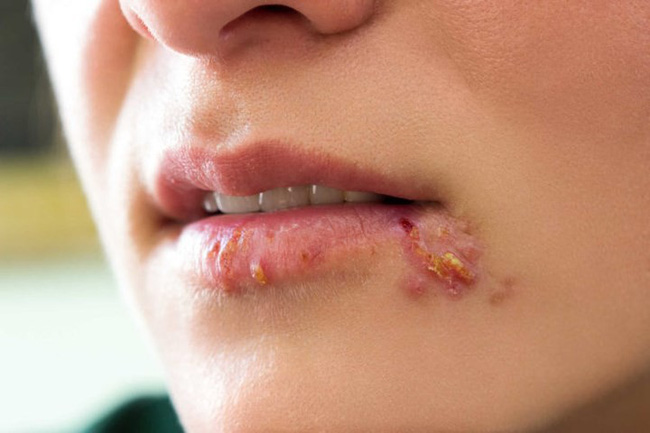 Các triệu chứng Herpes ở phụ nữ không nên bỏ qua - 4
