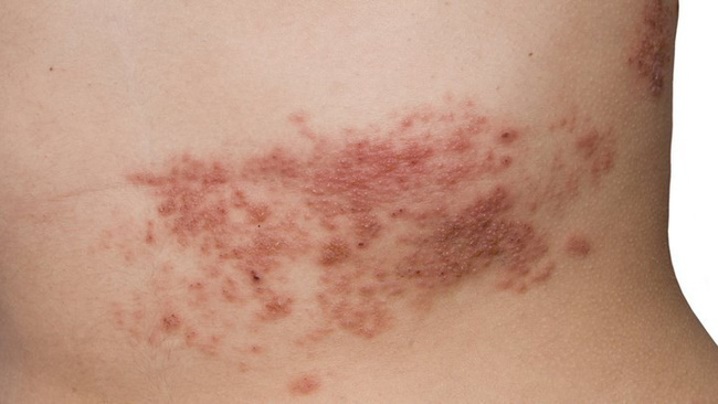 Các triệu chứng Herpes ở phụ nữ không nên bỏ qua - 5
