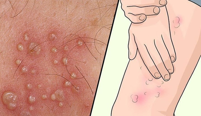 Các triệu chứng Herpes ở phụ nữ không nên bỏ qua - 7