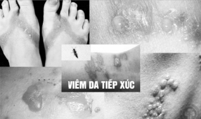 Hình ảnh viêm da tiếp xúc.