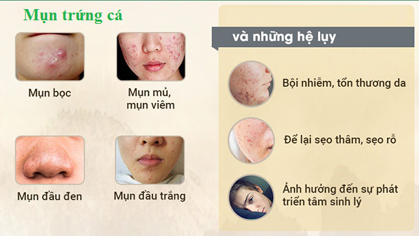 Những hệ lụy của mụn trứng cá.