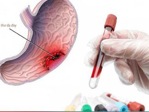 Xét nghiệm máu giúp phát hiện các chất chỉ điểm ung thư dạ dày.