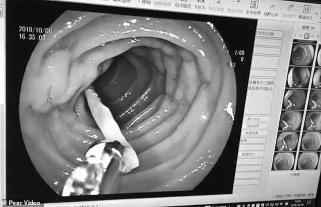 Các bác sĩ tiến hành loại bỏ vật thể ra khỏi cơ thể bà Ye.