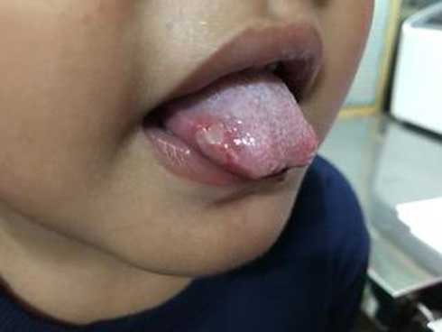 Hình ảnh bé H lưỡi bị loét.