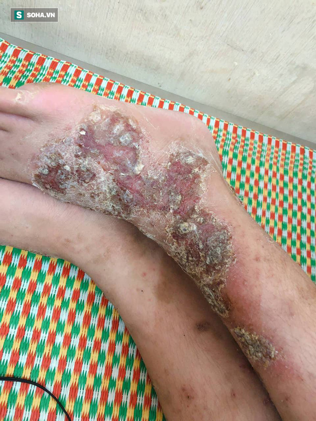 Bệnh nhân bị giun đũa chó, mèo sau điều trị tại khoa Điều trị chuyên ngành.