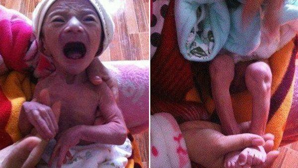 Cậu bé gầy gò, lão hóa như một người già