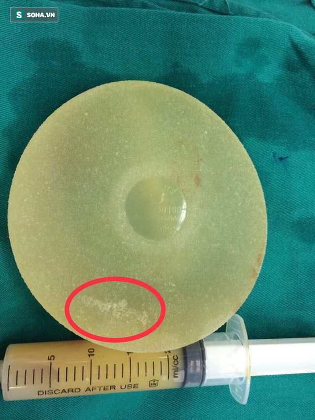 Túi ngực của bệnh nhân được lấy ra có nếp gấp, dịch hút ra màu vàng.