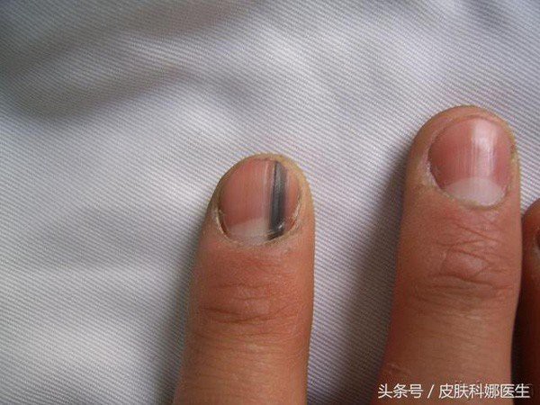 Nếu móng tay có biểu hiện bất thường, đừng chủ quan, có thể bạn đã mắc bệnh