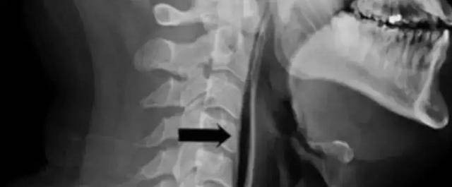 Bóng được chỉ định bởi mũi tên màu đen là không khí xâm nhập vào mô mềm của cổ