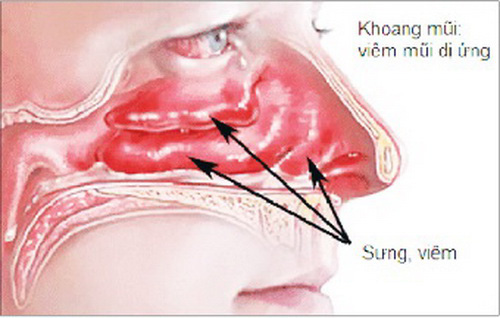 Xuất hiện quầng thâm ở mắt đừng chủ quan, rất có thể bạn đã mắc 1 trong 5 bệnh nguy hiểm này - Ảnh 6.