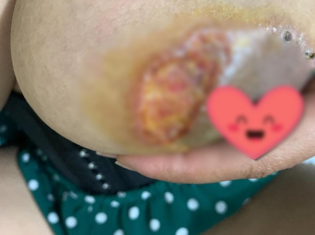 Cô gái trẻ bị lở loét, mưng mủ sau khi thực hiện nâng ngực chảy xệ ở spa chất lượng kém: Bài học đắt giá cho những chị em đang muốn thực hiện! - Ảnh 3.