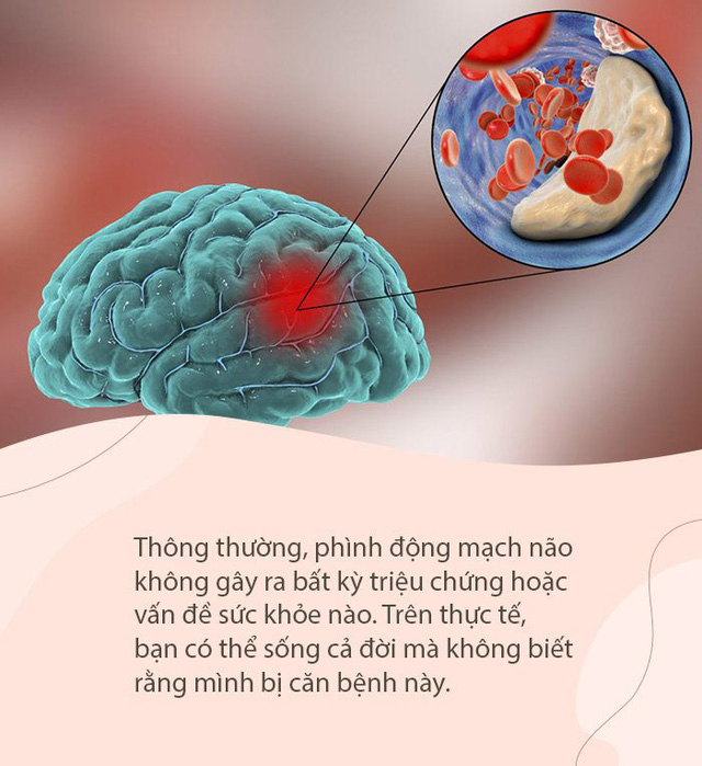 Người phụ nữ 50 tuổi bị vỡ mạch máu não, nhập viện cấp cứu chỉ vì gắng sức hát karaoke quá cao - Ảnh 2.