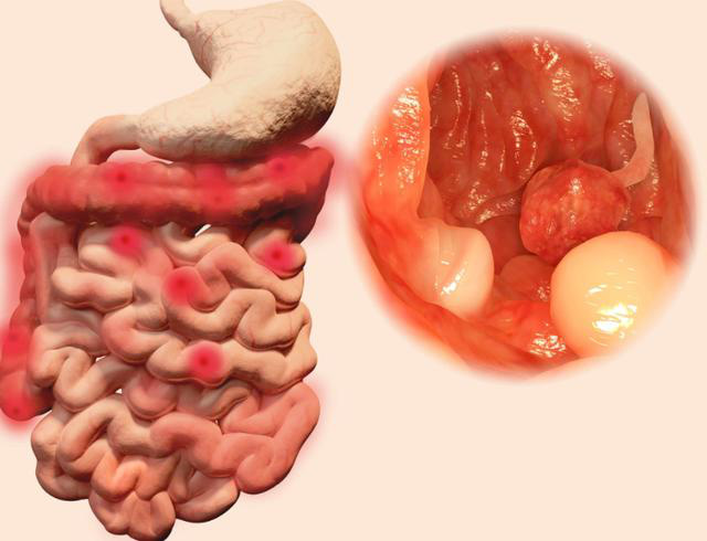 Đi vệ sinh có 3 dấu hiệu này, coi chừng ung thư ruột gõ cửa - Ảnh 2.