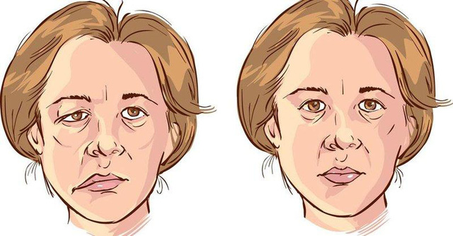 Phòng ngừa đột quỵ đúng cách – Bước đi quan trọng để bảo vệ sức khỏe! - Ảnh 1.