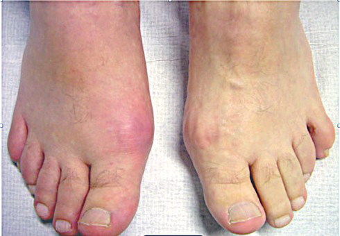 Ngày Tết, đối diện với bệnh gout và đái tháo đường như thế nào? - Ảnh 1.