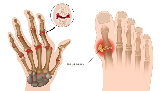 Sử dụng nước điện giải ion kiềm giúp cải thiện bệnh gout theo lời khuyên bác sĩ - Ảnh 2.
