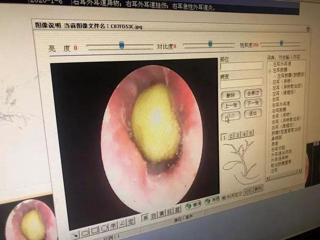 Cậu bé 8 tuổi bị đau tai, đi khám bác sĩ sốc khi phát hiện có “cây” mọc trong tai - Ảnh 3.