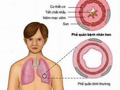 Bé 11 tuổi nhập viện vì mùi nước hoa của bố, chuyên gia cảnh báo những người cần tuyệt đối tránh - Ảnh 2.