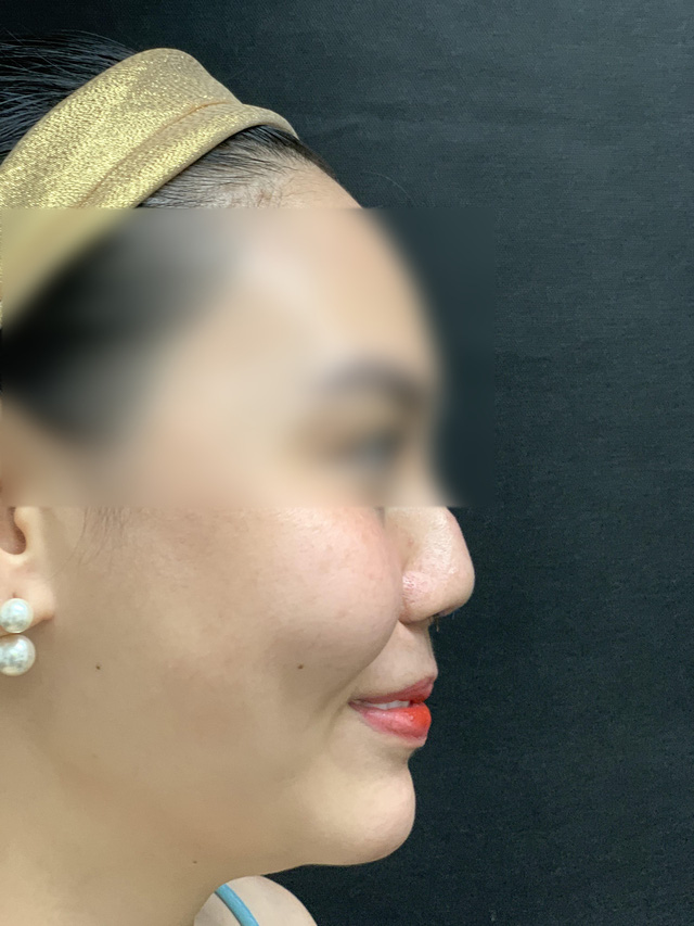 BS thẩm mỹ chia sẻ về ca khó nhất trong gần 20 năm làm nghề: Cứu chiếc mũi bị thẩm mỹ hỏng 8 lần đến mức biến dạng của cô gái trẻ - Ảnh 3.