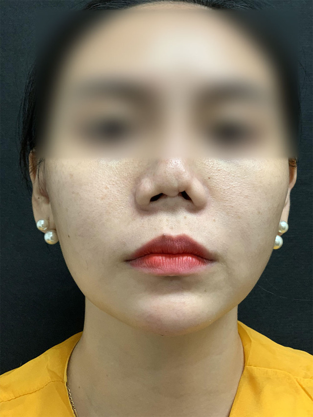 BS thẩm mỹ chia sẻ về ca khó nhất trong gần 20 năm làm nghề: Cứu chiếc mũi bị thẩm mỹ hỏng 8 lần đến mức biến dạng của cô gái trẻ - Ảnh 1.