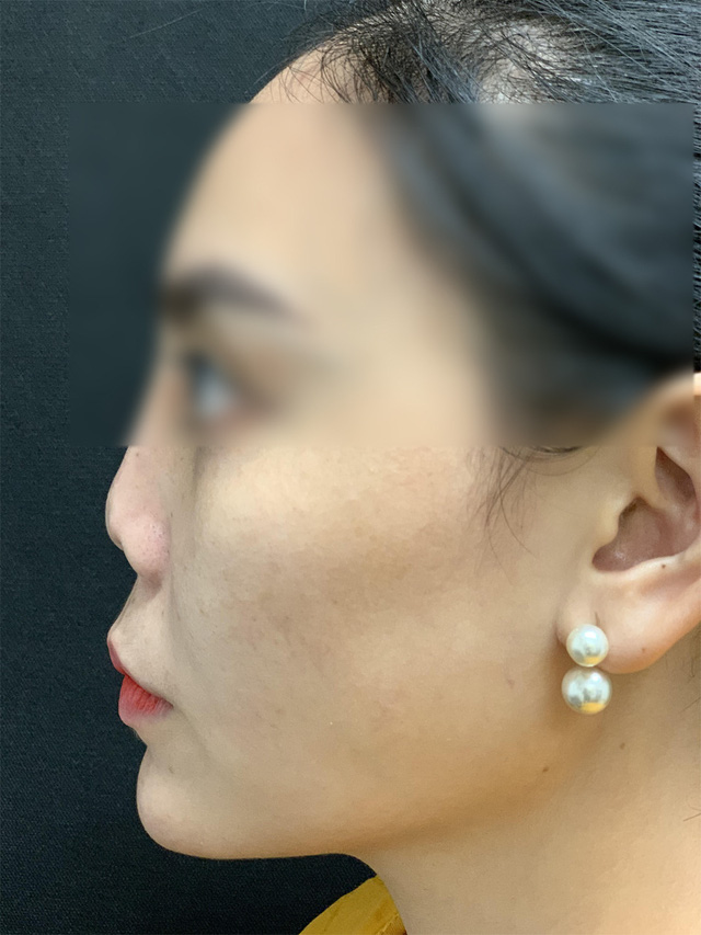 BS thẩm mỹ chia sẻ về ca khó nhất trong gần 20 năm làm nghề: Cứu chiếc mũi bị thẩm mỹ hỏng 8 lần đến mức biến dạng của cô gái trẻ - Ảnh 2.