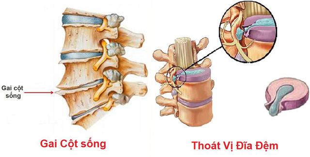 Tại sao rất nhiều người bị gai đốt sống, thoát vị đĩa đệm đều dùng Cốt Thoái Vương? - Ảnh 1.