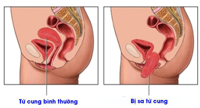 Từ vụ người phụ nữ phải cấp cứu vì bị sa sinh dục, chuyên gia cảnh báo những chị em nhất định phải biết những điều này - Ảnh 2.