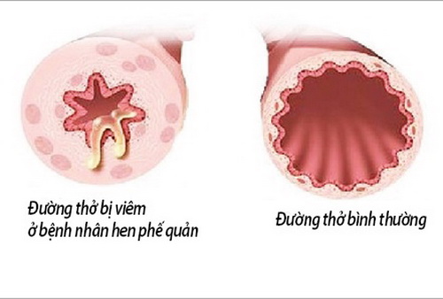 Hình ảnh phế quản của người bệnh hen.