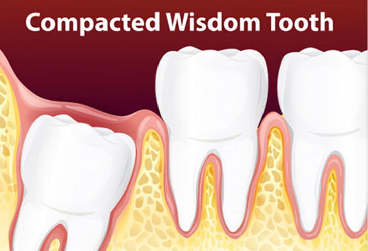 Schedule A FREE Wisdom Teeth Consultation 