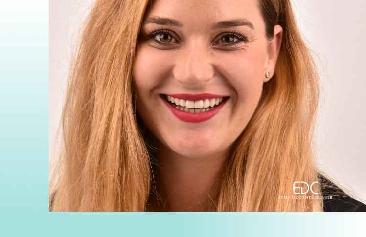 Porcelain Veneers Image