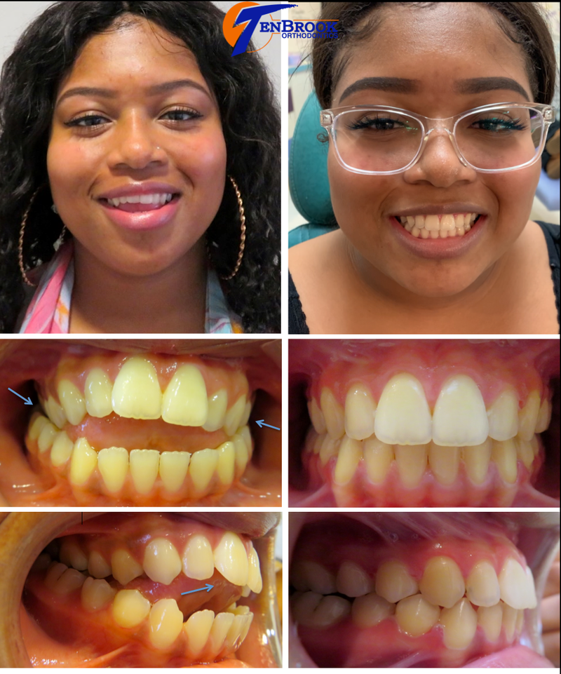 Adult Braces in New Jersey TenBrook Orthodontics