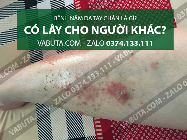 nấm da tay chân có lây không