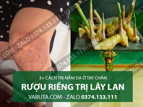 Cách chữa trị nấm da bàn chân bằng Rượu Riềng