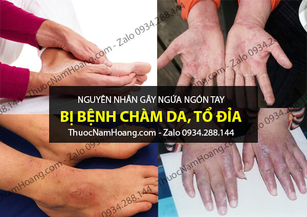 cách chữa ngứa đầu ngón tay