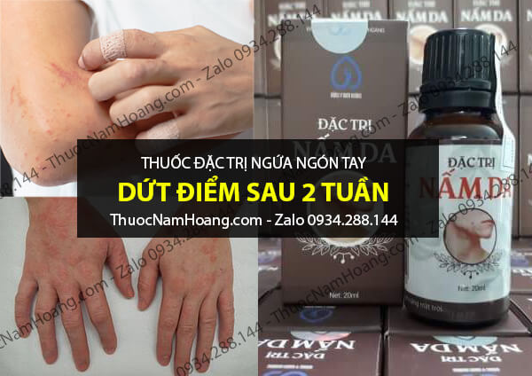 thuốc trị ngứa đầu ngón tay chân