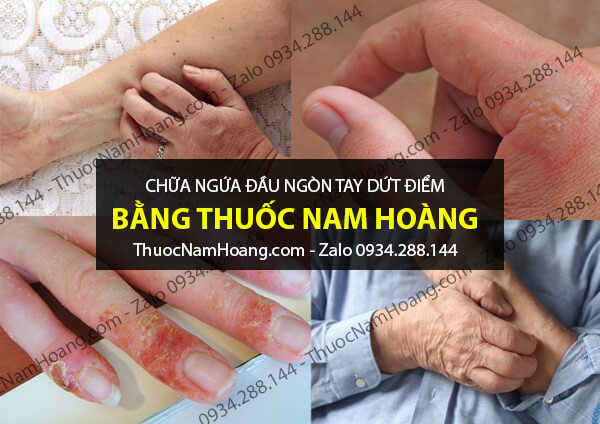 chữa ngứa đầu ngón tay chân dứt điểm