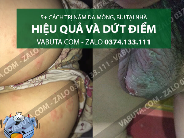 cách trị nấm da ở bùi và mông