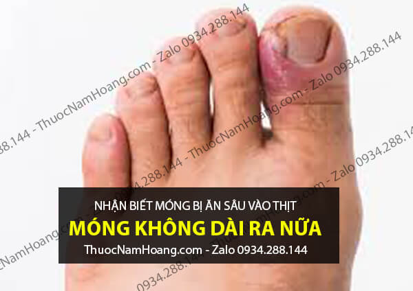 móng tay chân bị ăn sâu vào thịt
