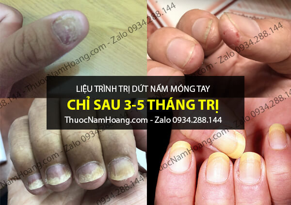 móng tay chân bị ăn sâu vào thịt
