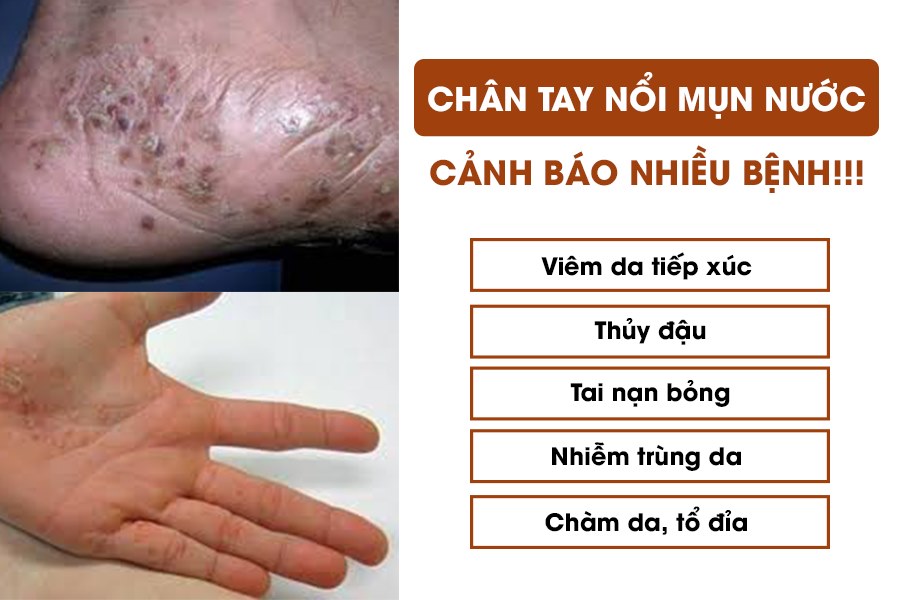nguyên nhân nổi mụn nước ở tay