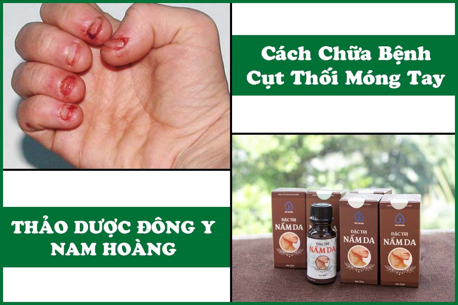 thuốc trị cụt thối móng tay
