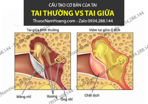 viêm tai giữa có đi bơi không