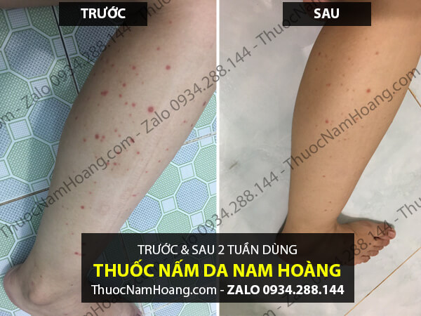 cách chữa chàm khô ở tay chân