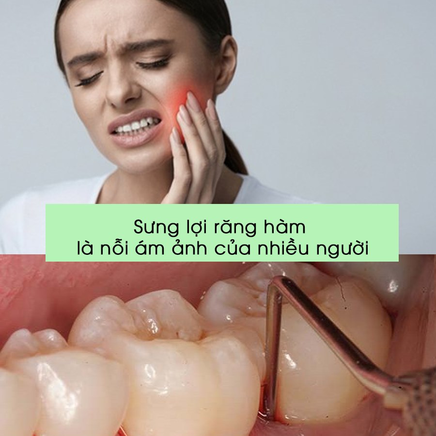 viêm lợi răng hàm phải làm sao