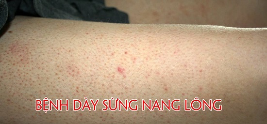 bệnh dày sừng nang lông