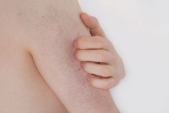 cách trị dày sừng nang lông
