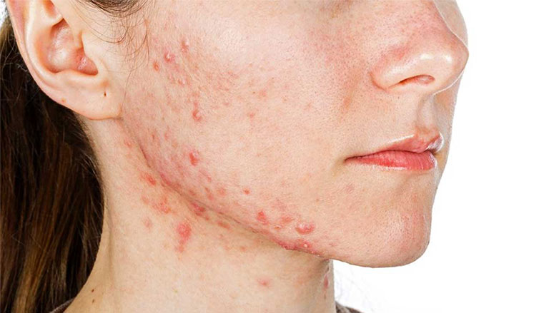 Da mặt bị ngứa và nổi mụn
