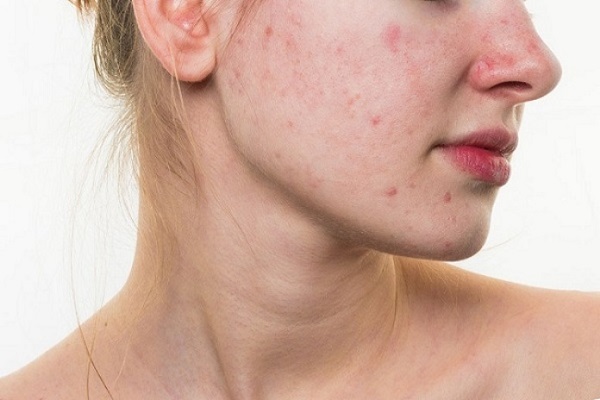 Da mặt bị ngứa và nổi mụn do nhiễm khuẩn
